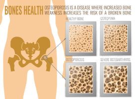 Pilates for Osteoporosis